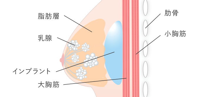 乳腺下法