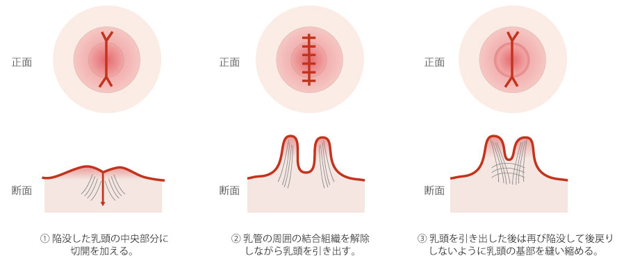 陥没乳頭